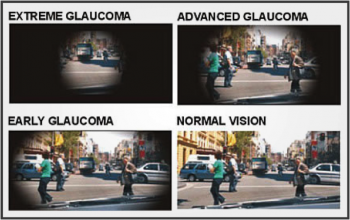 glaucoma image